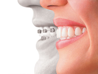 The image shows a split-screen graphic with one side displaying a person s smiling face and the other showing an overlaid illustration of a toothy smile, likely representing dental health or orthodontic care.