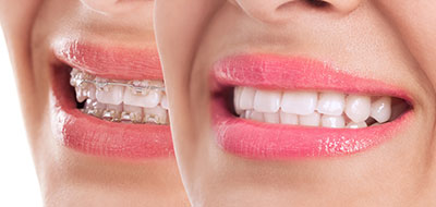 An image of a woman s smiling face with a close-up view of her teeth, showcasing both her natural smile and an enhanced smile with braces.