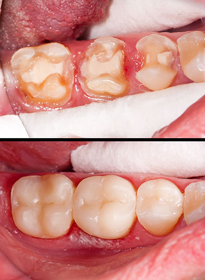 The image shows a close-up of a person s mouth with teeth that appear to be in poor condition, possibly due to decay or gum disease. The teeth are discolored and some are missing, indicating dental health issues.