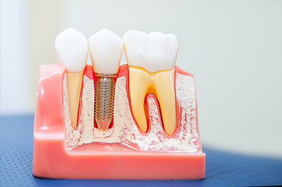 The image shows a dental model with multiple teeth, including one that has been modified to include an implant.