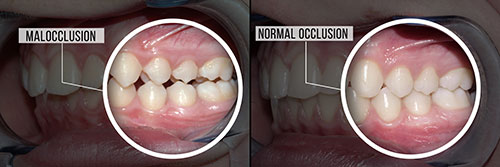 The image shows a side-by-side comparison of a person s teeth before and after what appears to be dental treatment, with a close-up view of the teeth in both states, highlighting the difference.