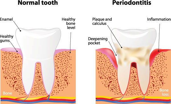 The image shows a diagrammatic representation of the stages of gum disease, from normal to periodontitis, with annotations that explain each stage and its associated symptoms.