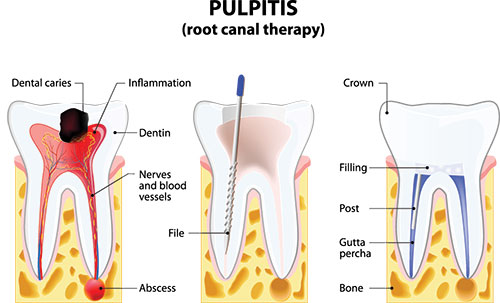 The image is a medical illustration showing a cross-section of the upper jaw with teeth, gums, and anatomical structures including roots, nerves, and dental implants.