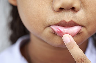 A young child with a noticeable skin condition, examining their finger against the affected area.