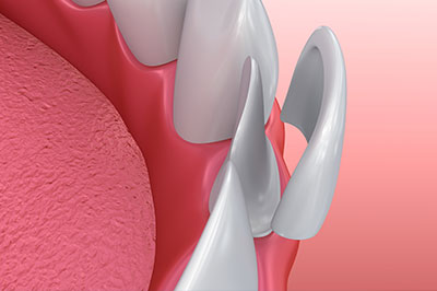 The image shows a close-up of a human mouth with a focus on the teeth and gum, set against a pink background which appears to be a tongue or palate.