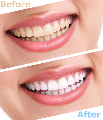 The image displays a before-and-after comparison of dental care, showing a smile with yellow teeth transformed into a bright white smile after treatment.