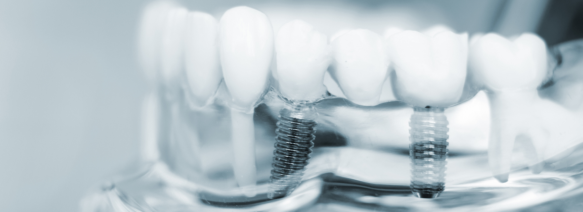 The image shows a close-up of multiple teeth with visible dental implants, arranged in a row against a white background.