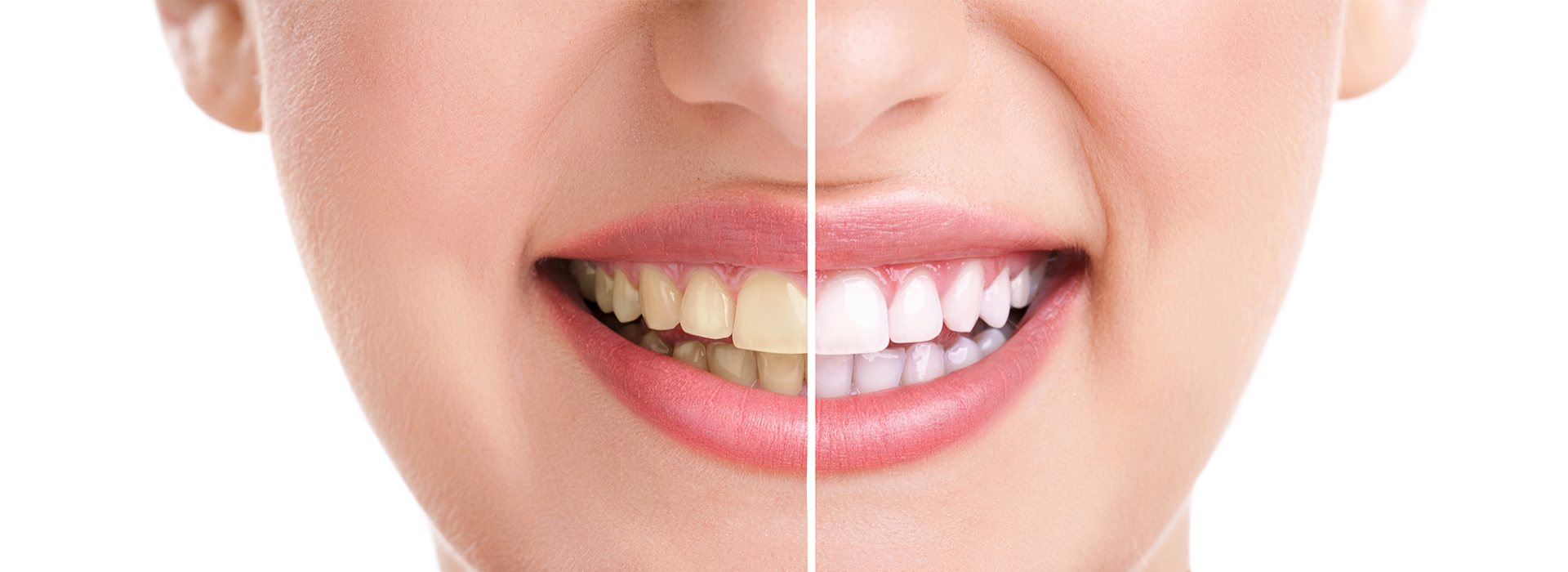 A close-up of a smiling woman s face, with an overlaid graphic showing the before and after results of teeth whitening.