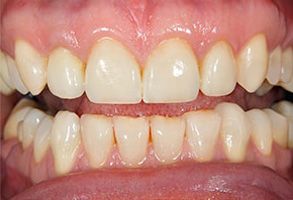 Image of a close-up view of a person s teeth, showcasing yellowing and staining.