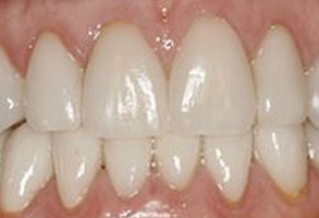 The image shows a close-up of a person s teeth, which appear to be in the process of being straightened or aligned with braces.