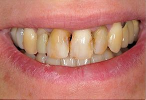 The image shows a close-up of a person s teeth with noticeable discoloration and decay, indicating poor oral hygiene or dental health issues.