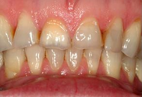 The image shows a close-up of a person s teeth with visible staining and discoloration, particularly on the front upper teeth.