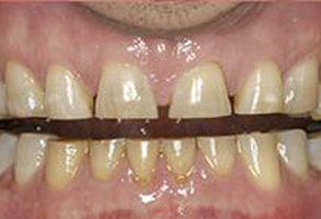 The image displays a close-up of a person s teeth, which appear to be discolored and in need of dental care.